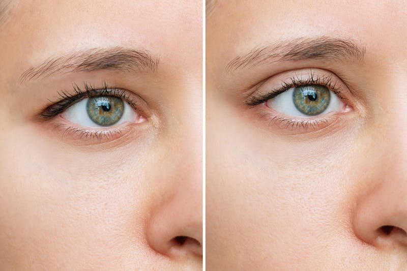 Hooded Eye Surgery Hooded Eye Surgery