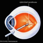 Epiretinal Membrane Surgery