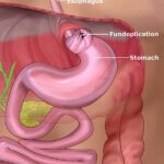 Fundoplication Surgery