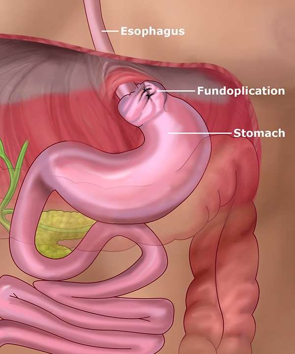 Fundoplication Surgery Fundoplication Surgery