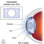 ICL Eye Surgery