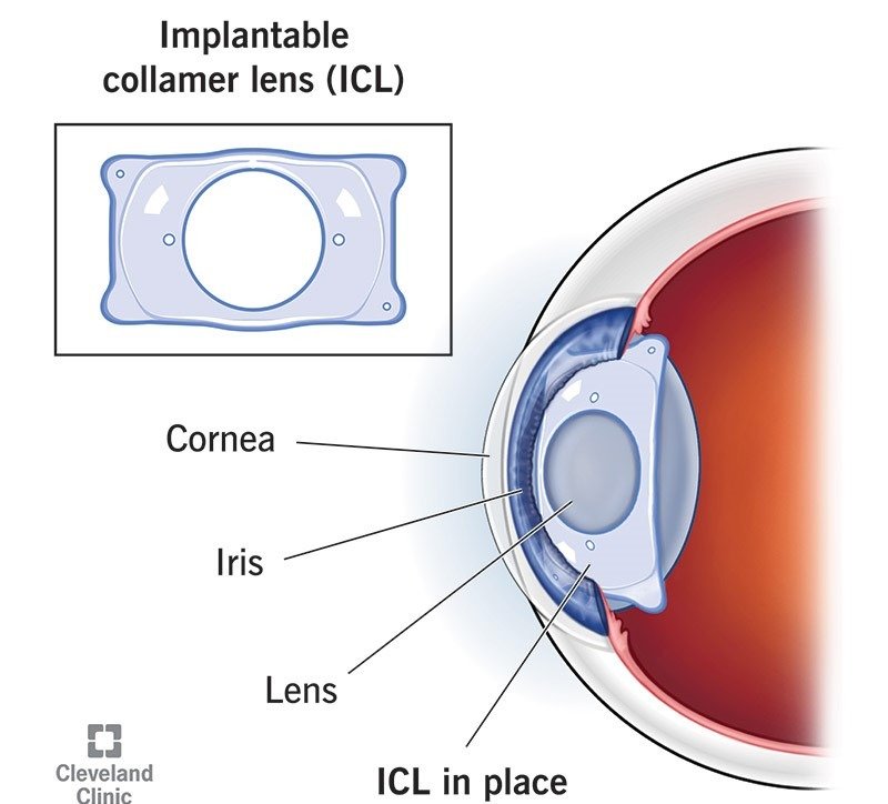 ICL Eye Surgery ICL Eye Surgery