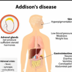 Addison’s Disease