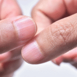 Vertical Ridges On Nails Vitamin Deficiency