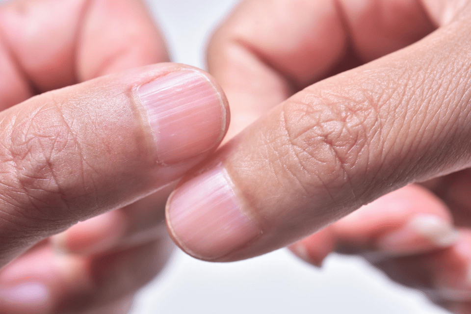 Vertical Ridges On Nails Vitamin Deficiency