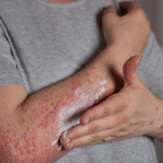 Castleman’s Disease