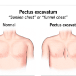 Pectus Excavatum Surgery