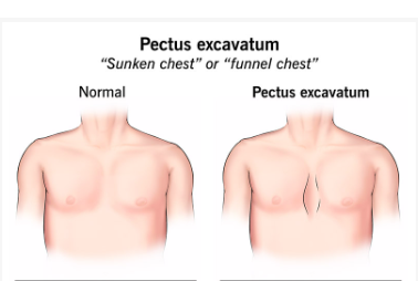 Pectus Excavatum Surgery Pectus Excavatum Surgery