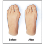 Bunion Surgery Recovery Time