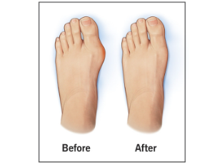 Bunion Surgery Recovery Time