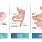 Bariatric Surgery Ireland