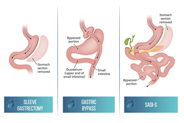Bariatric Surgery Ireland