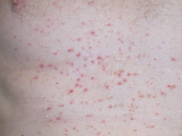 Grover’s Disease