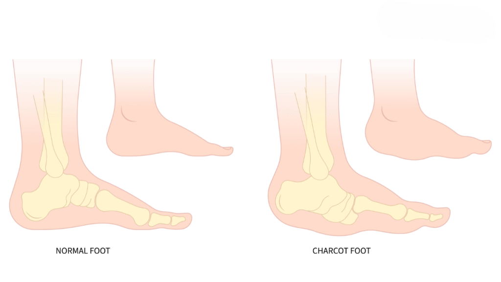 Charcot’s Disease Charcot’s Disease