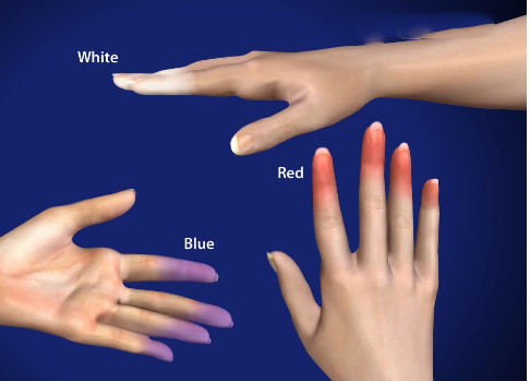 Raynaud's Disease Raynaud's Disease