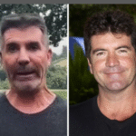 Simon Cowell Before and After Surgery