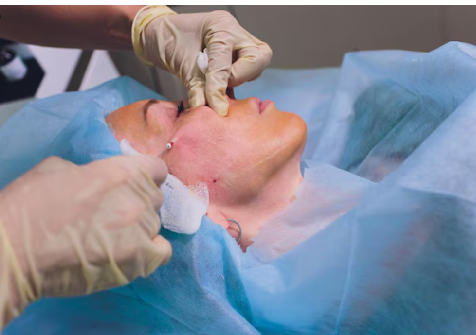 Mohs Surgery Recovery Mohs Surgery Recovery