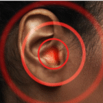 Ménière’s Disease